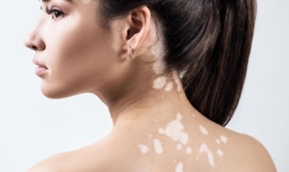 Homeopathie met succes toegepast bij vitiligo